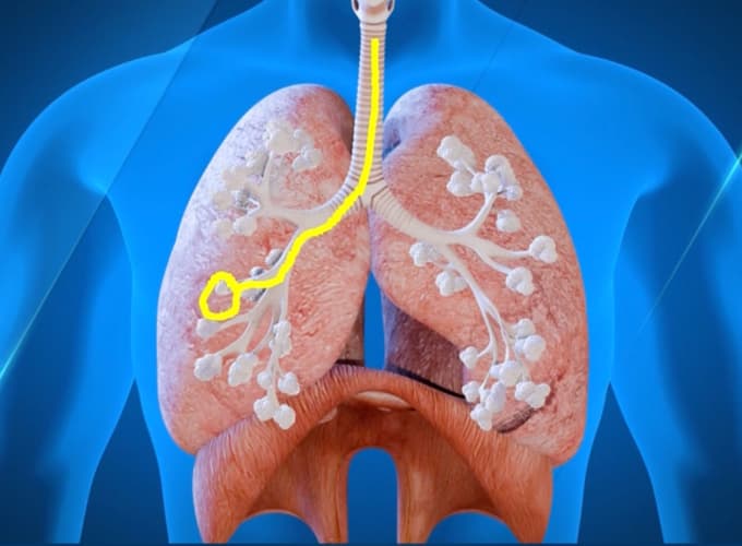 Illustrazione dei polmoni con bronchi e alveoli evidenziati, e un segmento marcato in giallo