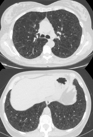 Cisti polmonari diffuse in una paziente affetta da LAM